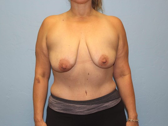 breast-augmentation-lift-2-1