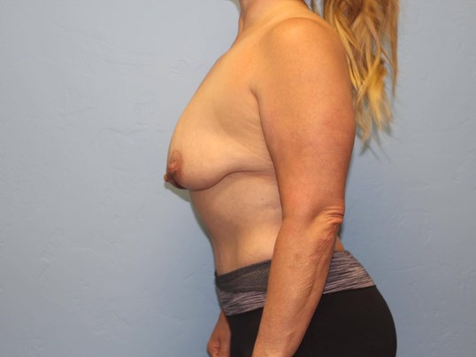 breast-augmentation-lift-2-5