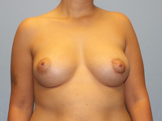 breast-augmentation-lift-3-2
