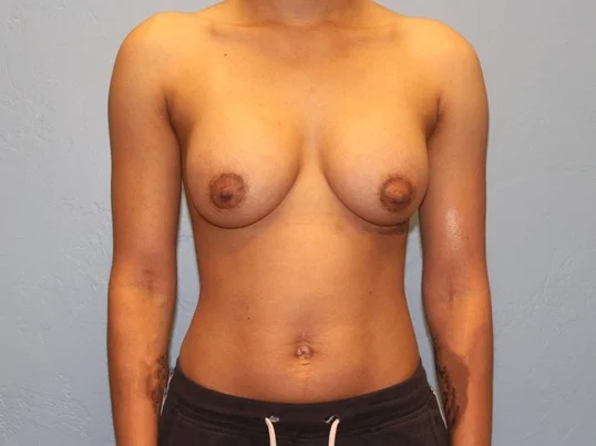 breast-augmentation-lift-4-2