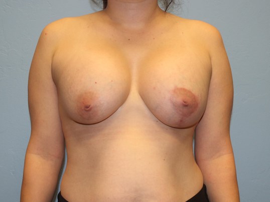 breast-augmentation-lift-7-2
