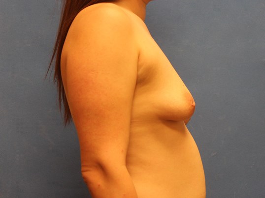 breast-augmentation-lift-7-5