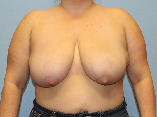 breast-augmentation-lift-8-1