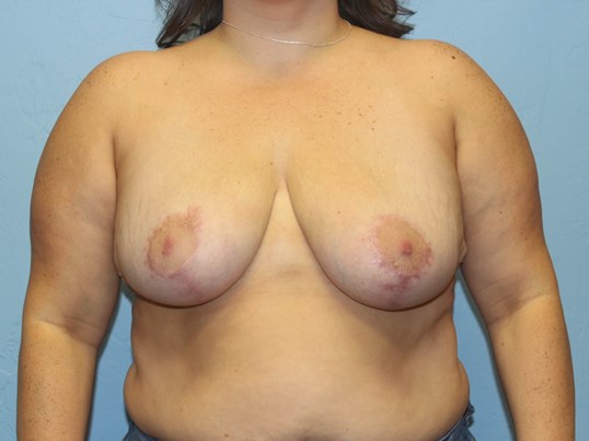 breast-augmentation-lift-8-2