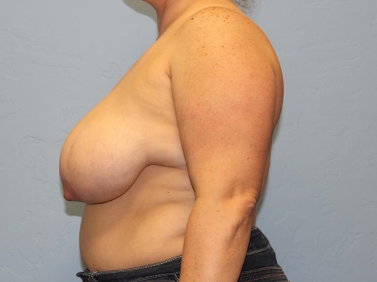 breast-augmentation-lift-8-9