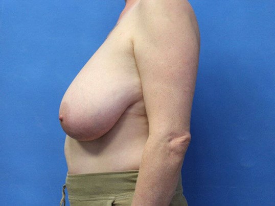 breast-augmentation-lift-9-3
