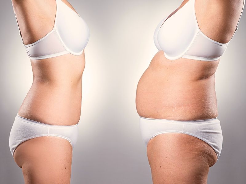 Achieving Transformation: Abdominoplasty Before and After