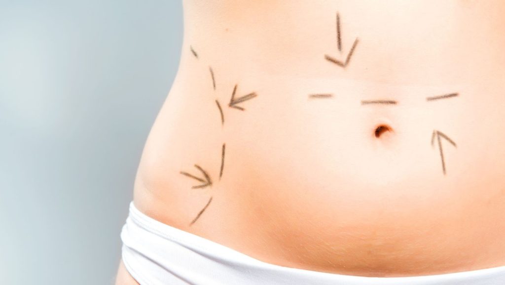 Tummy Tuck vs. Liposuction – Perfect Choice for Sculpting Your Dream Body